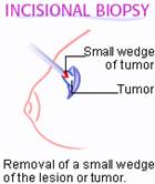 Incisional biopsy